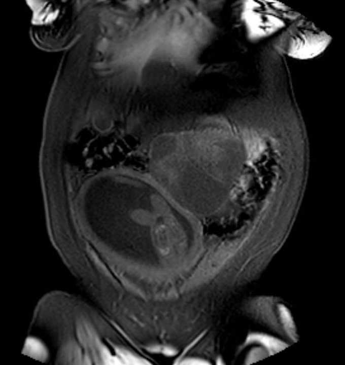 Colon adenocarcinoma with Krukenberg tumors, advanced pregnancy (Radiopaedia 67279-76645 E 14).jpg