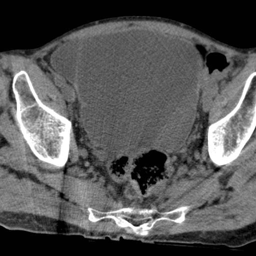 Colon cancer with calcified liver metastasis (Radiopaedia 74423-85309 Axial non-contrast 100).jpg