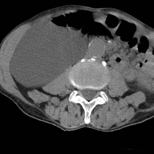 Colon cancer with calcified liver metastasis (Radiopaedia 74423-85309 Axial non-contrast 56).jpg