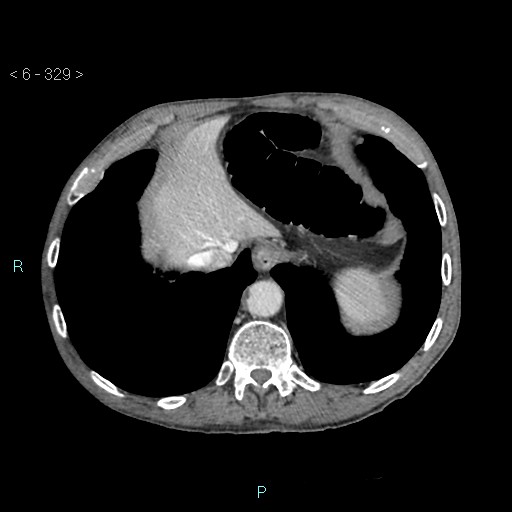 Colonic cancer (ultrasound and TC imaging) (Radiopaedia 50346-55713 B 329).jpg