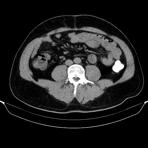 Colonic lipoma with colo-colic intussusception (Radiopaedia 58944-66200 Axial C+ rectal 38).jpg