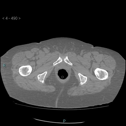 Colonic lipomas (Radiopaedia 49137-54244 Axial bone window 218).jpg