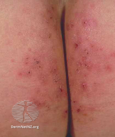File:Dermatitis herpetiformis (DermNet NZ immune-dh1).jpg