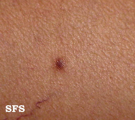 File:Dermatofibroma (Dermatology Atlas 2).jpg