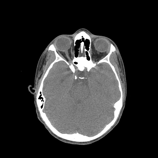 Nasal pyogenic granuloma (lobular capillary hemangioma) (Radiopaedia 85536-101244 Axial non-contrast 103).jpg