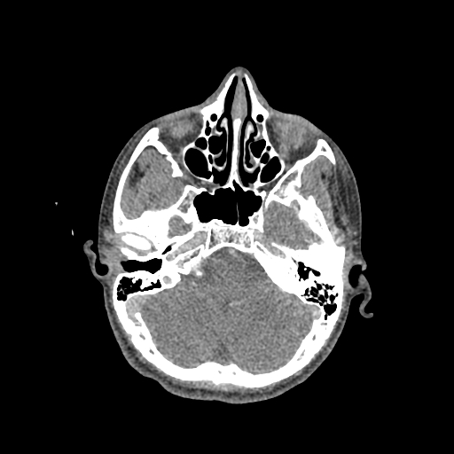File:Nasal pyogenic granuloma (lobular capillary hemangioma) (Radiopaedia 85536-101244 C 94).jpg