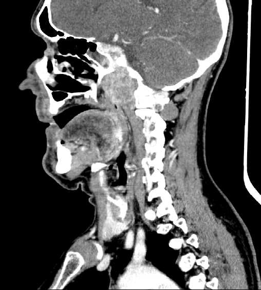 File:Nasopharyngeal carcinoma - infiltrating the clivus (Radiopaedia 62583-70875 C 32).jpg