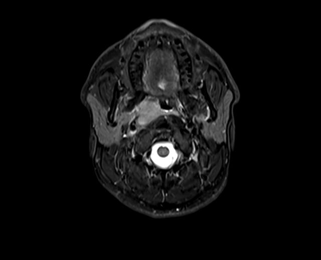 File:Nasopharyngeal carcinoma with perineural spread (Radiopaedia 55030-61380 Axial STIR 23).jpg
