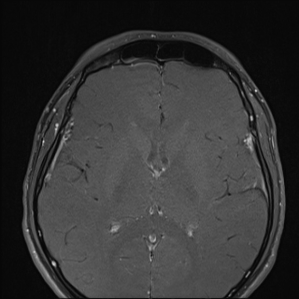 Nasopharyngeal carcinoma with skull base invasion (Radiopaedia 53415-59485 Axial T1 C+ fat sat 7).jpg