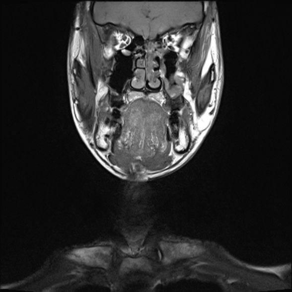 Nasopharyngeal carcinoma with skull base invasion (Radiopaedia 53415-59485 Coronal T1 30).jpg