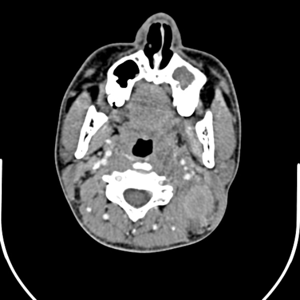 Nasopharyngeal carcinoma with skull base invasion (Radiopaedia 53415-59705 A 83).jpg