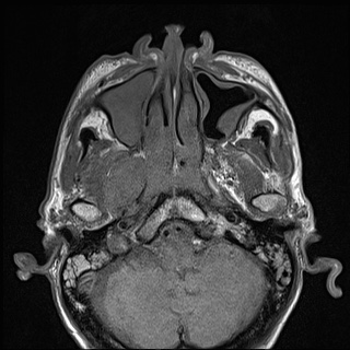 Nasopharyngeal carcinoma with skull base invasion (Radiopaedia 59258-66600 B 18).jpg