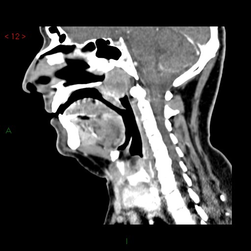 File:Nasopharyngeal lymphoma (Radiopaedia 54235-60432 B 16).jpg