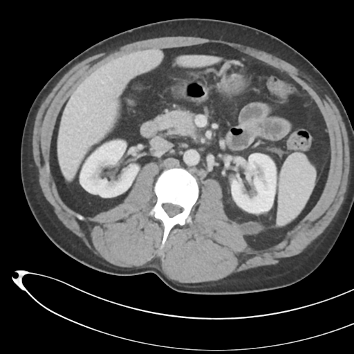 File:Necrotizing pancreatitis with acute necrotic collections (Radiopaedia 38829-41012 B 35).png