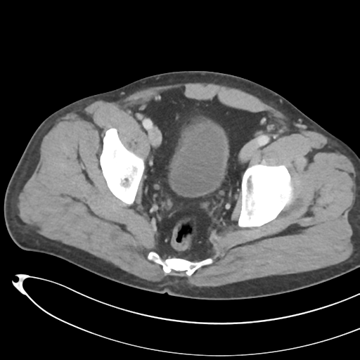 File:Necrotizing pancreatitis with acute necrotic collections (Radiopaedia 38829-41012 B 75).png