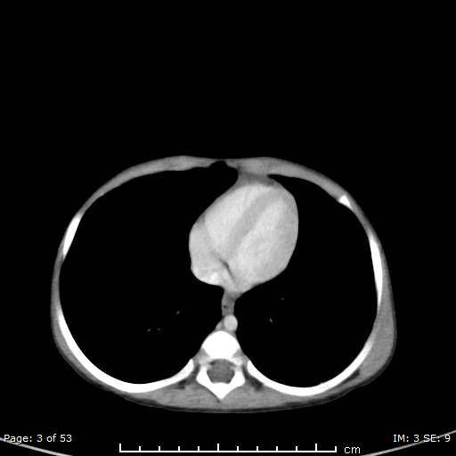 Nephroblastomatosis (Radiopaedia 41934-44935 A 3).jpg