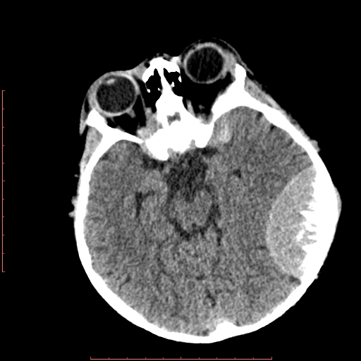 File:Neuroblastoma skull metastasis (Radiopaedia 56053-62683 Axial non-contrast 7).jpg