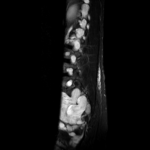File:Neurofibromatosis type 1- extensive spinal involvement and Christmas tree sign (Radiopaedia 60610-68332 Sagittal STIR 6).jpg