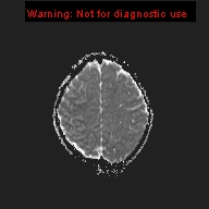 File:Neurofibromatosis type 1 with optic nerve glioma (Radiopaedia 16288-15965 Axial ADC 5).jpg
