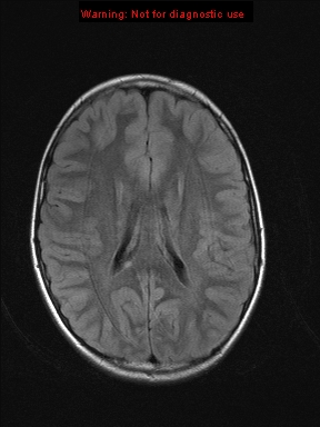 File:Neurofibromatosis type 1 with optic nerve glioma (Radiopaedia 16288-15965 Axial FLAIR 10).jpg