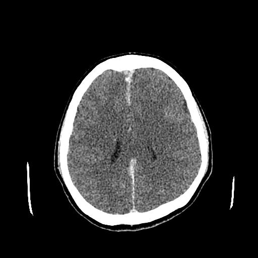 File:Neurofibromatosis type 2 (Radiopaedia 25389-25637 Axial C+ 62).jpg