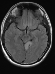 File:Neurofibromatosis type 2 (Radiopaedia 44936-48838 Axial FLAIR 10).png