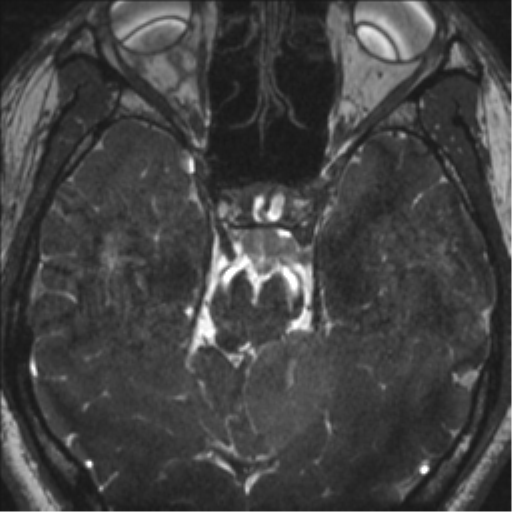 Neurofibromatosis type 2 (Radiopaedia 44936-48838 E 51).png