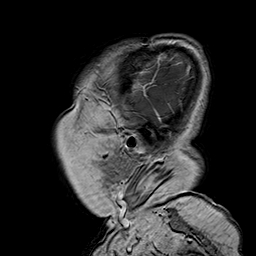 File:Neurofibromatosis type 2 (Radiopaedia 8713-9518 Sagittal T1 C+ 4).jpg