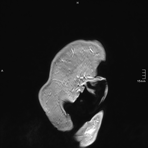 Neurosarcoidosis - involvement of the mesial temporal lobes (Radiopaedia 67429-76820 Sagittal T1 C+ 4).jpg