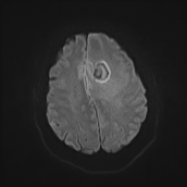 File:Neurotoxoplasmosis - concentric target sign (Radiopaedia 70644-80784 Axial DWI 16).jpg