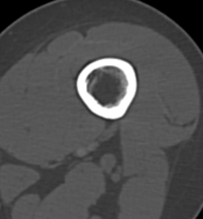 Non-ossifying fibroma - femur (Radiopaedia 82786-97042 Axial bone window 26).jpg