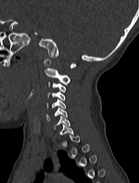 Normal CT cervical spine - pediatric (Radiopaedia 52549-58462 Sagittal bone window 156).jpg