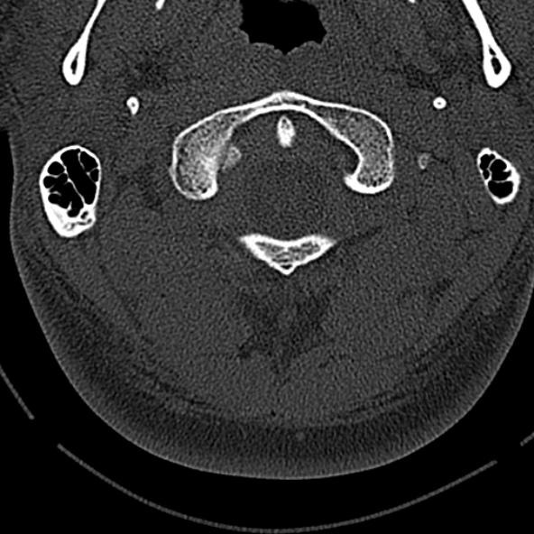 Normal CT of the cervical spine (Radiopaedia 53322-59305 Axial bone window 51).jpg