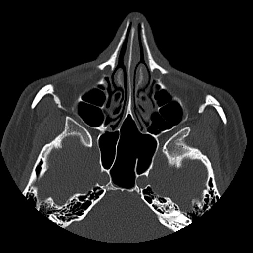 Normal CT paranasal sinuses (Radiopaedia 42286-45390 Axial bone window 60).jpg