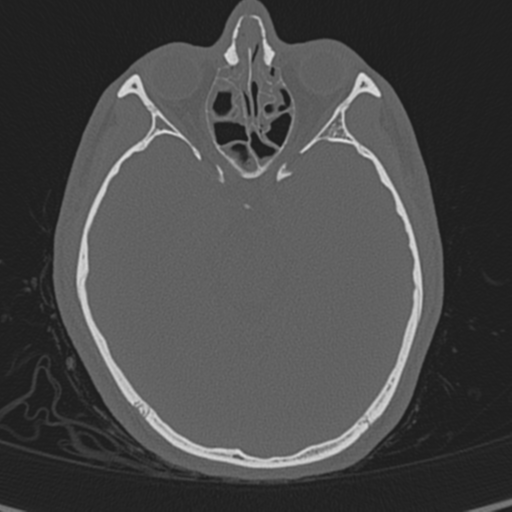 Normal CT skull (Radiopaedia 40798-43459 A 61).png