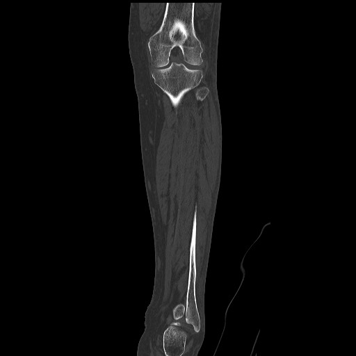 Normal CT tibia and fibula (Radiopaedia 51195-56848 Coronal non-contrast 40).jpg