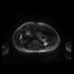 Normal MRI abdomen in pregnancy (Radiopaedia 88001-104541 Axial DWI 67).jpg
