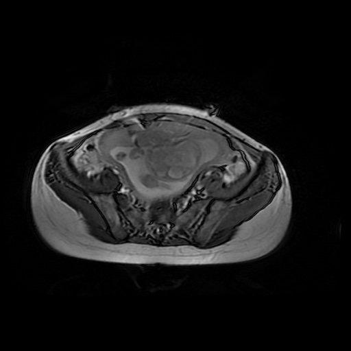 File:Normal MRI abdomen in pregnancy (Radiopaedia 88001-104541 Axial Gradient Echo 41).jpg