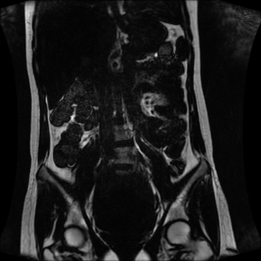 Normal MRI abdomen in pregnancy (Radiopaedia 88001-104541 N 74).jpg