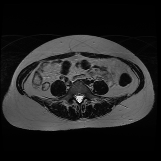 Normal MRI abdomen in pregnancy (Radiopaedia 88005-104548 Axial T2 9).jpg