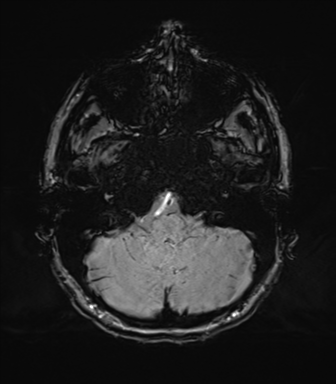 Normal brain MRI (TLE protocol) (Radiopaedia 40748-43405 Axial SWI 15).png