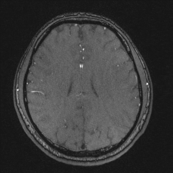 Normal brain MRI including MRA (Radiopaedia 48748-53763 Axial MRA 145).jpg