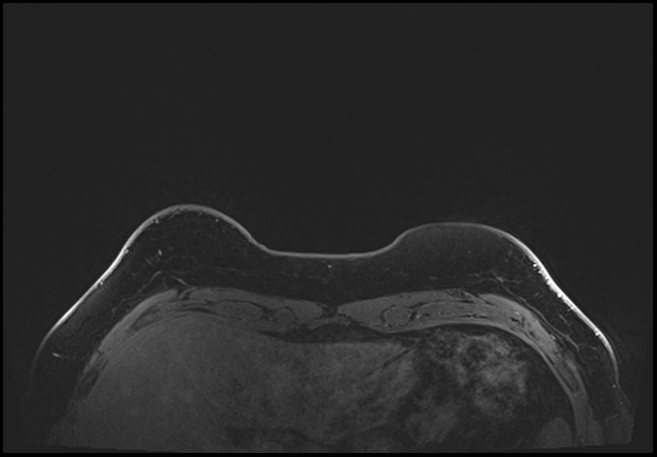 Normal breast MRI - dense breasts (Radiopaedia 80454-93850 C 16).jpg
