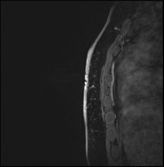 Normal breast MRI - dense breasts (Radiopaedia 80454-93850 I 164).jpg