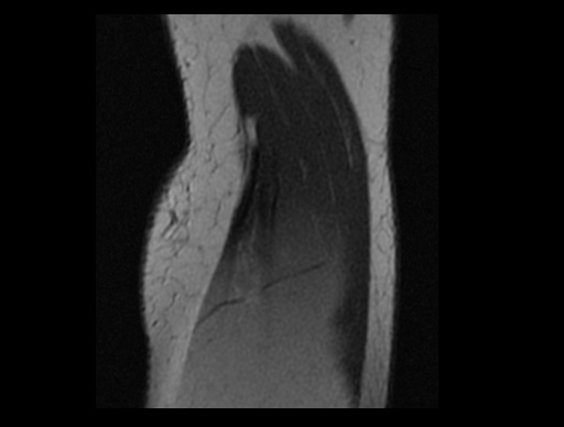 File:Normal elbow arthrograms (Radiopaedia 75550-86805 Sagittal PD 8).jpg