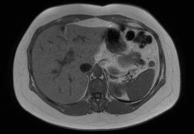 File:Normal liver MRI with Gadolinium (Radiopaedia 58913-66163 Axial T1 in-phase 22).jpg