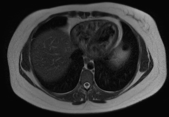 File:Normal liver MRI with Gadolinium (Radiopaedia 58913-66163 Axial T2 30).jpg