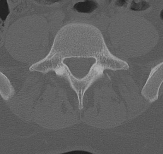 File:Normal lumbar spine CT (Radiopaedia 46533-50986 Axial bone window 58).png