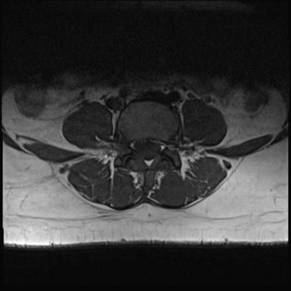 File:Normal lumbar spine MRI- 3 T (Radiopaedia 53280-59250 Axial 20).jpg