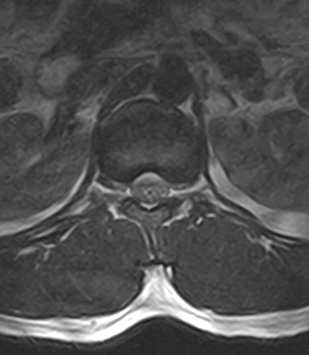 Normal lumbar spine MRI - low-field MRI scanner (Radiopaedia 40976-43699 Axial T2 18).jpg
